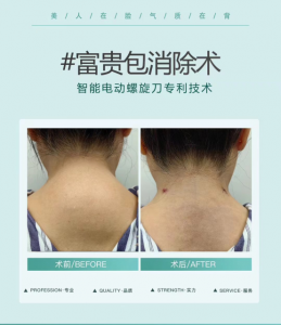富贵包仪器价格贵吗，老年人可以做吗，做完有哪些不适吗