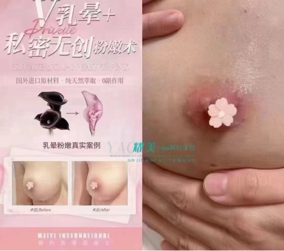 傲诺拉丰胸效果好不好，网上卖的贵吗-月光资讯网